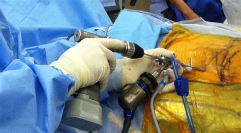 Endoscopic Spine Surgery - Spine & Joint Clinic