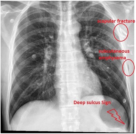 How to pick a pneumothorax on a supine CXR - Emergency Medicine Kenya Foundation