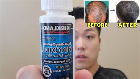 WATCH THIS IF YOU'RE NOT SEEING HAIR GROWTH RESULTS WITH MINOXIDIL ...