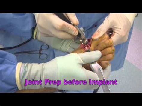 Big Toe Joint Implant Surgery For Arthritis By San Francisco Podiatrist