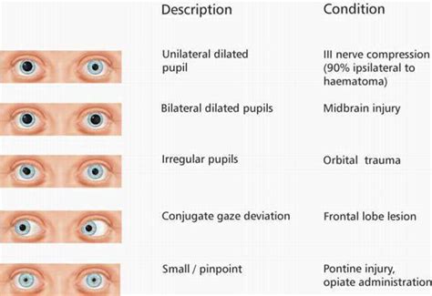 PERRL - Pupils Equal Round Reactive to Light. | Trauma nurse, Emergency ...