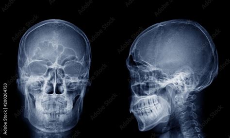 Very good quality X-ray image of normal human skull front (AP) view and side (Lateral) view ...