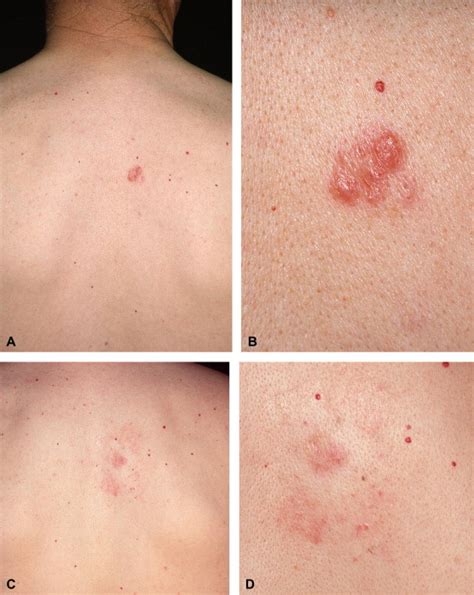 Clinicopathologic features of early lesions of primary cutaneous ...