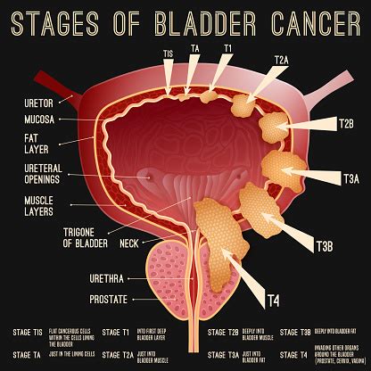 Tahap Kanker Kandung Kemih Ilustrasi Stok - Unduh Gambar Sekarang - Kandung kemih, Metastase ...