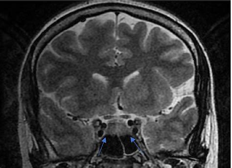 MRI Imaging of Double Pituitary Microadenoma: A Rare Preoperative Diagnosis | Cureus