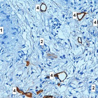 Histology sample of epithelial ovarian cancer, lymphatic microvessel... | Download Scientific ...