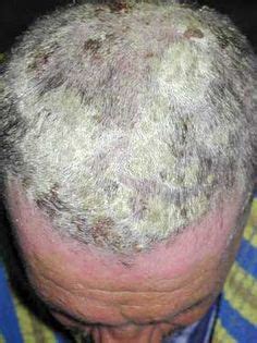 What is scalp psoriasis? on Pinterest | Salicylic Acid, Skin Treatments and Psoriasis Scalp