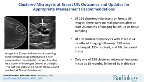 Breast Cyst Ultrasound