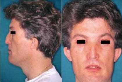 Craniodiaphyseal Dysplasia - Pictures, Treatment, Symptoms