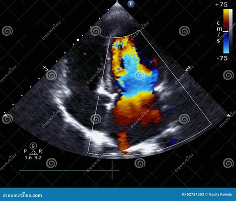 Doppler Echocardiography Stock Image | CartoonDealer.com #52734865