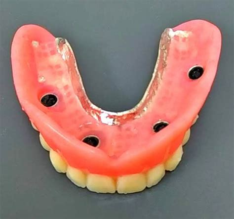 Locator Implant Retained Dentures - Burnham Denture Clinic in Edmonton ...