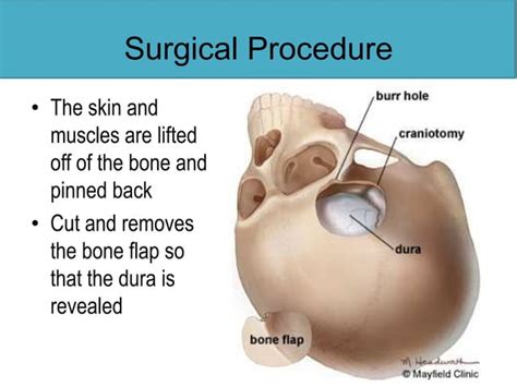 Craniotomy | PPT