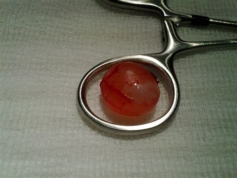 Spermatocele (Epididymal Cyst)