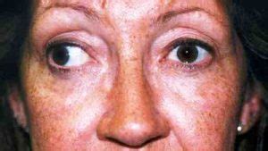 Before and After Eye Muscle Surgery Photos | Sarasota, Bradenton, Florida