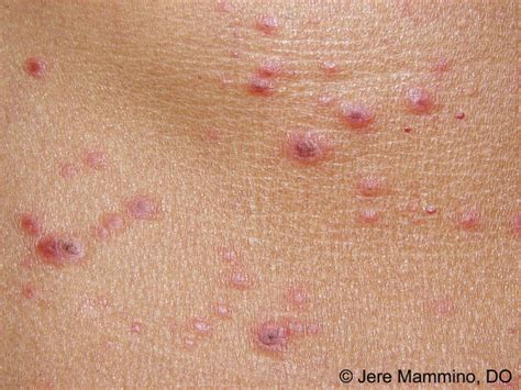 Pityriasis Lichenoides - American Osteopathic College of Dermatology (AOCD)