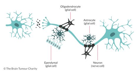 Glioblastoma brain tumours | The Brain Tumour Charity