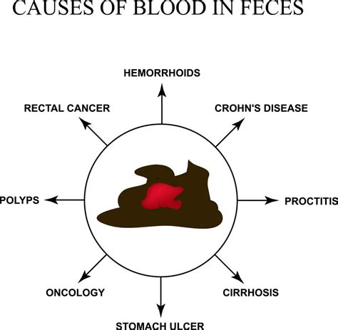 Causes Of Blood In Stool | STD.GOV Blog