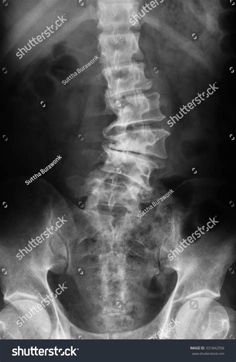 X-Ray Image Of Lumbosacral Spine Showing Osteoarthritis Of Lumbar. Stock Photo 331842056 ...