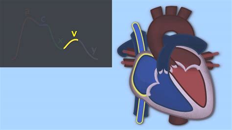 Interpreting Central Venous Pressure Waveforms by J. DiNardo ...