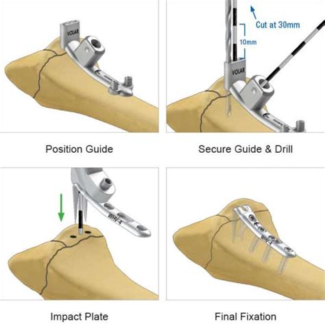 Volar Hook Plate - Wrist Fracture Fixation Plate - TriMed Inc.