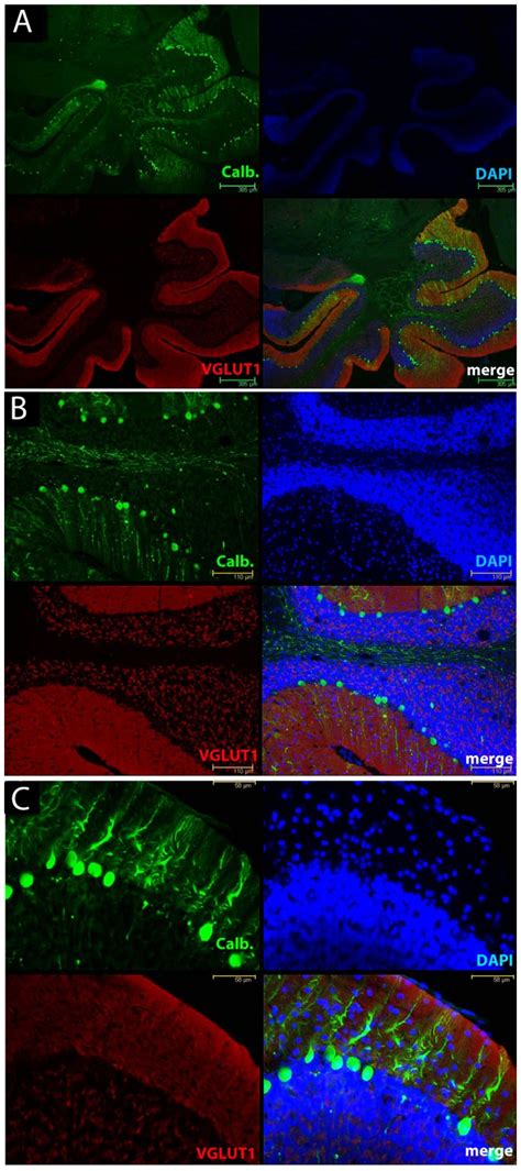 Calbindin immunoreactivity (green) illustrates the severe loss of ...