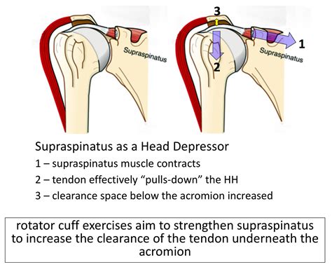 Rotator Cuff 3 - Supraspinatus Tendonitis - Treatment - Cambridge Shoulder