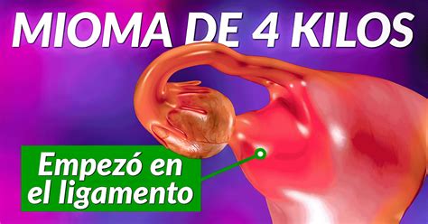 Extracción de un mioma de 4 kilos – Creafam