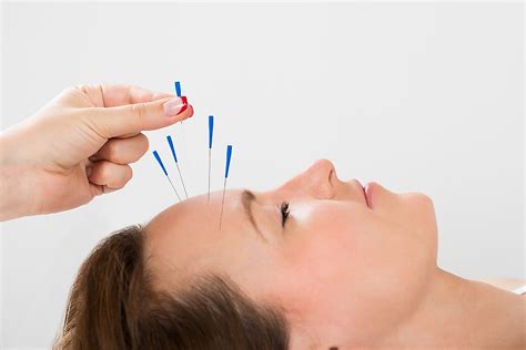 Tracing The Origins Of Acupuncture, A Practice In Traditional Chinese ...