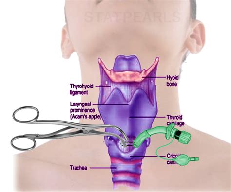 Cricothyrotomy Article