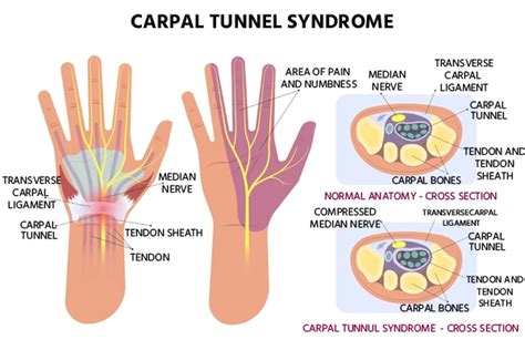 Carpal Tunnel Syndrome: Causes And Symptoms - Ask The Nurse Expert