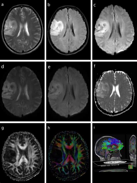 Brain Tumor Color Mri