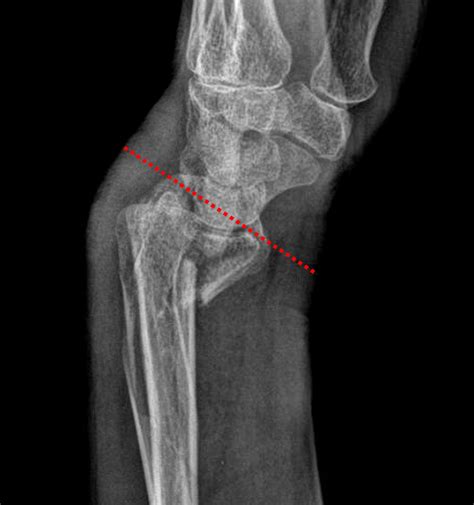 Smith Fracture Radiology