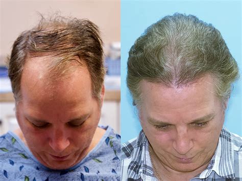 3500 Grafts - Norwood Hair Loss Classification V - Carolina Hair Surgery