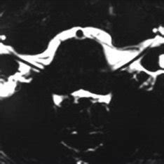 Bilaterally enlarged vestibular aqueduct - temporal bone MRI - axial... | Download Scientific ...