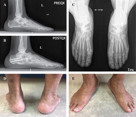 Lateral osteotomy of the calcaneus in the treatment of Müller-Weiss disease