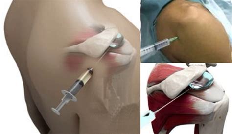 Fig 7A. Subacromial Injection - Cambridge Shoulder