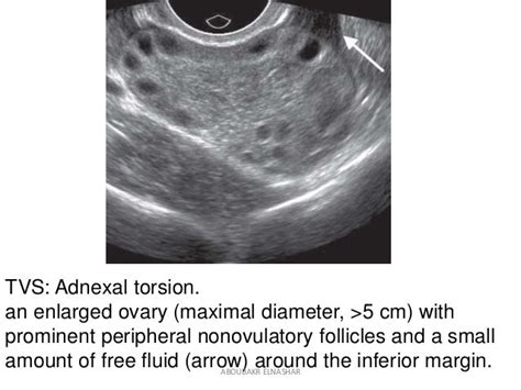 Adnexal torsion SOGC2017Aboubakr Elnashar