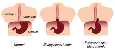 Hiatal Hernia | Riverside Surgical & Weight Loss Center, llc