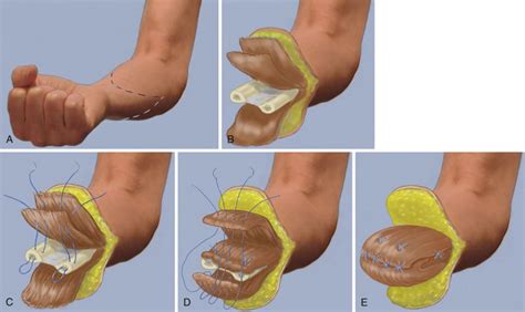 Major Limb Amputations and Prosthetics | Musculoskeletal Key