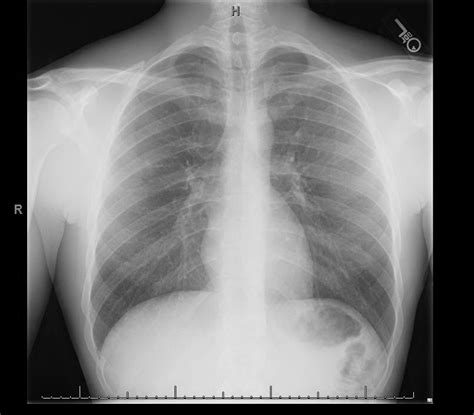 Hennepin Ultrasound | Spontaneous Pneumothorax