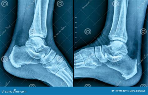 Heel Spur X Ray