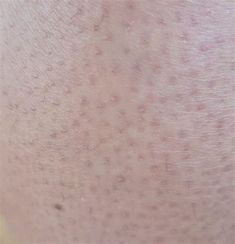 Keratosis Pilaris: What is it, and Can it be Treated? - Dr Nathan Holt