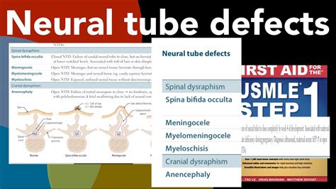 Neural tube defects, Spina bifida occulta, Meningocele ...