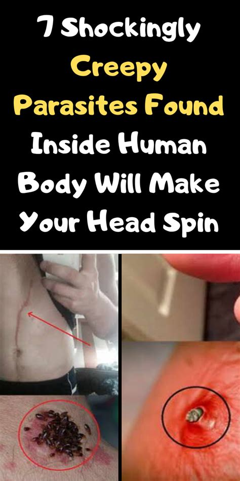 7 Shockingly Creepy Parasites Found Inside Human Body Will Make Your ...