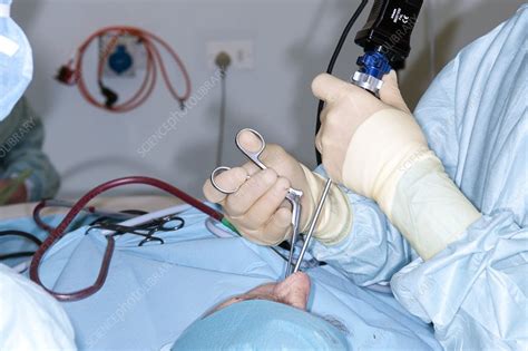 Nasal polyp surgery - Stock Image - C008/7840 - Science Photo Library