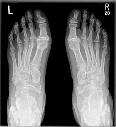 MTP joint replacement for hallux rigidus: a developing field