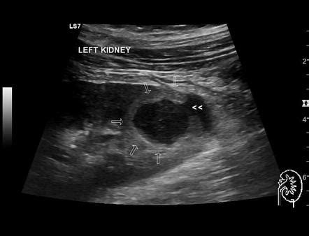 Kidney Abscess Ultrasound