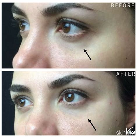 Tear Trough Treatment Fillers | SkinViva Manchester Cheshire