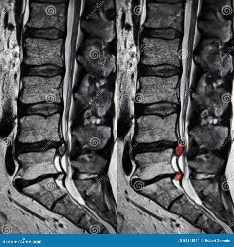 Disc Herniation, Lumbar Spine MRI Stock Photo - Image: 54848811