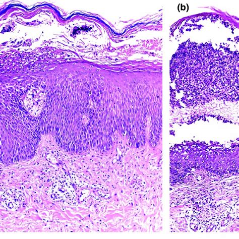 (a,b) Generalized pustular psoriasis, showing epidermal hyperplasia ...